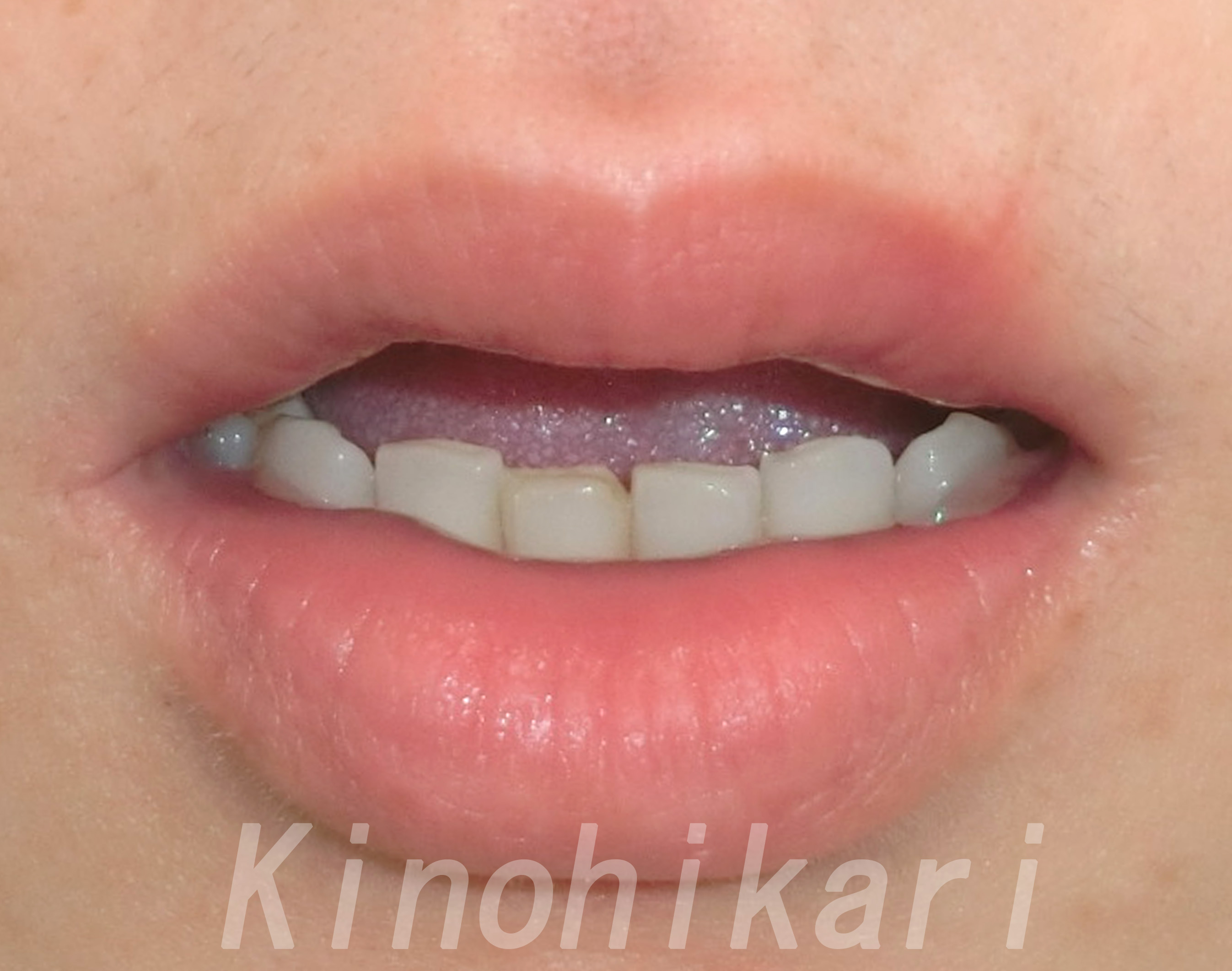 1.唇红粘膜切除术的操作及修复-口腔颌面外科手术与手术技巧-医学