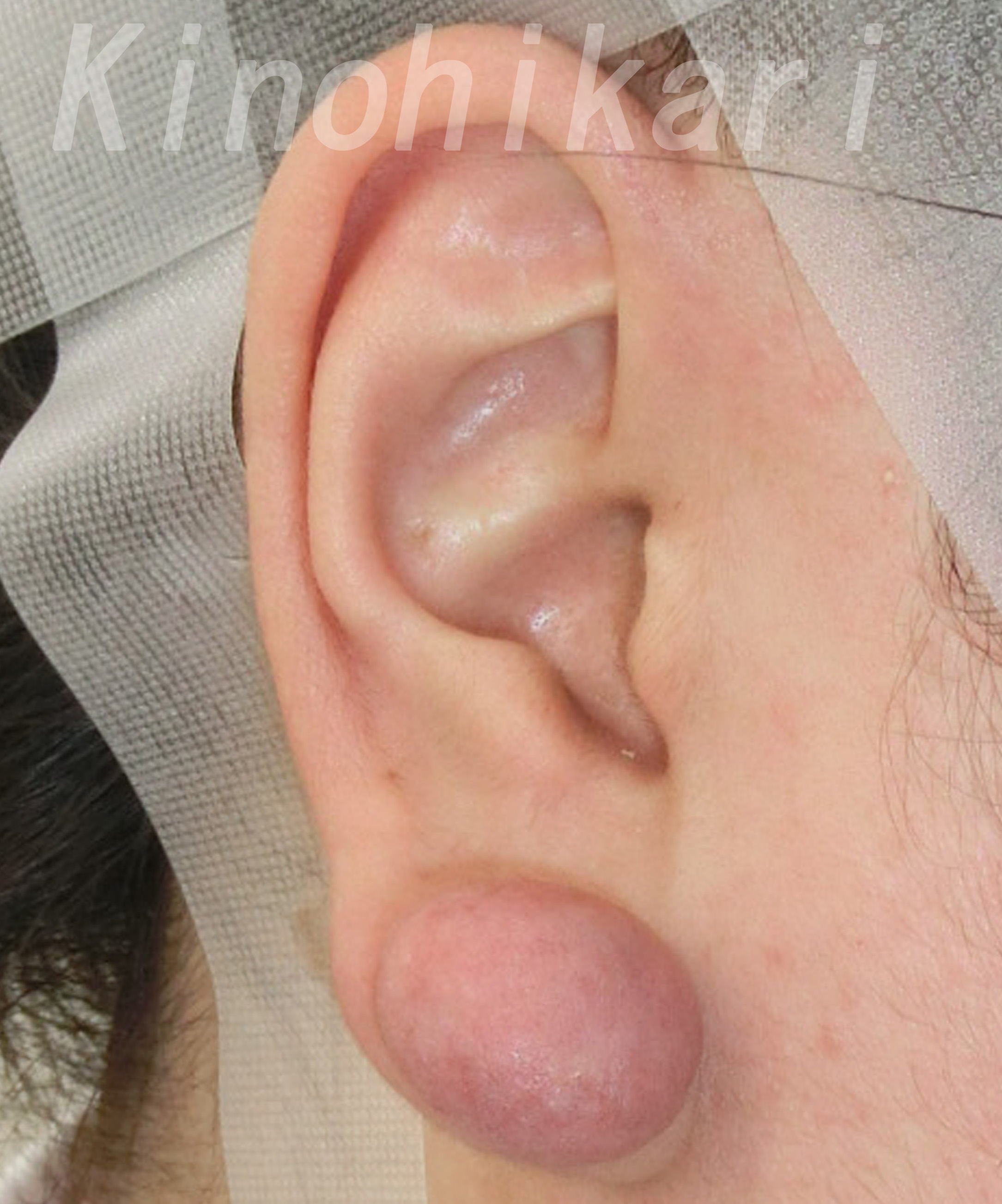 耳の形成 | 奈良 樹のひかり形成外科・皮ふ科