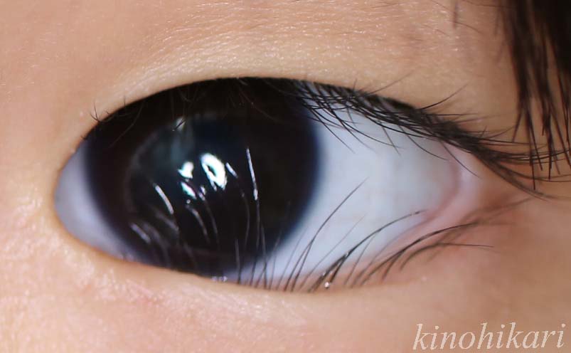 目の形成 眼瞼形成外科 奈良 樹のひかり形成外科 皮ふ科