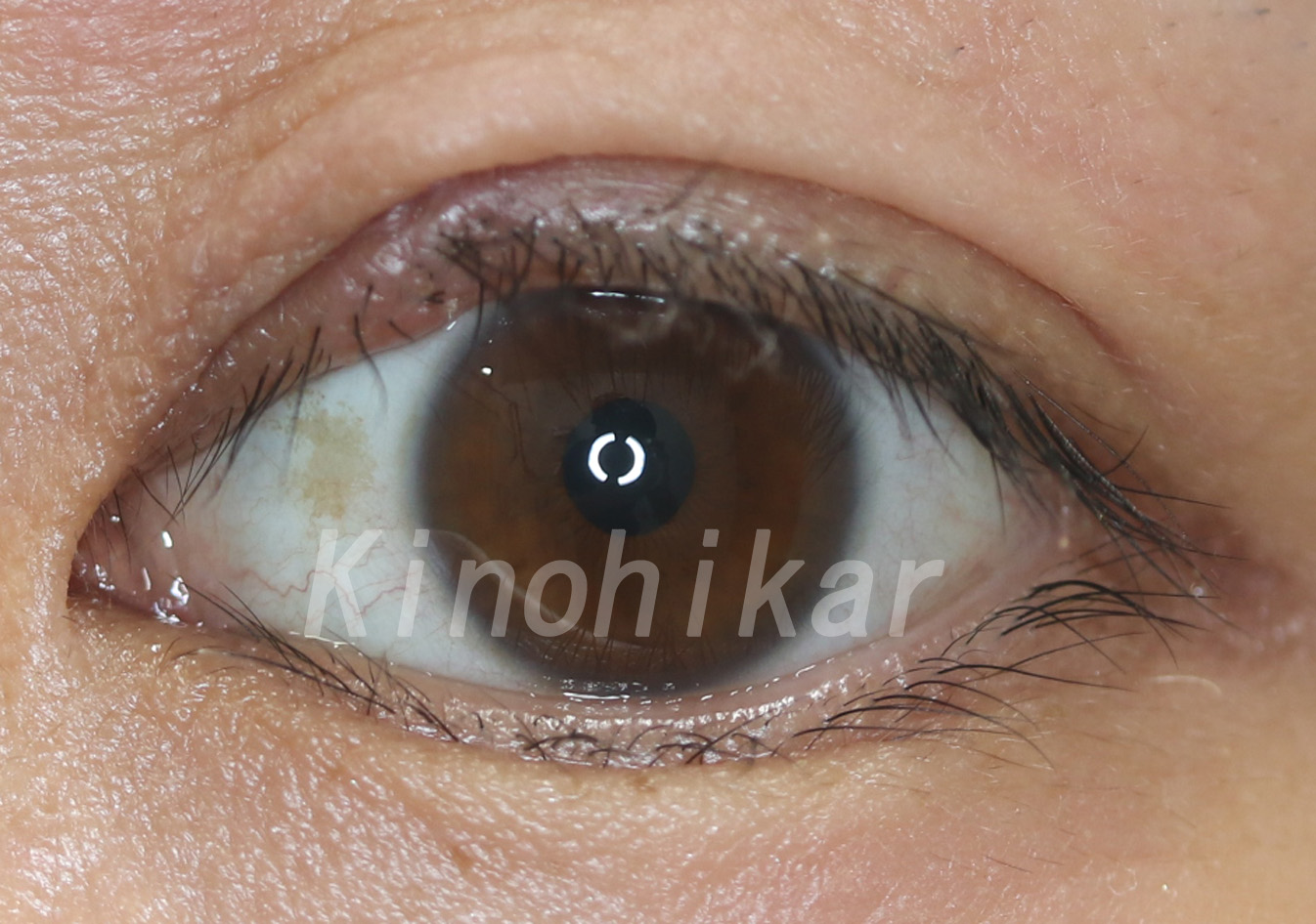目の形成 眼瞼形成外科 奈良 樹のひかり形成外科 皮ふ科