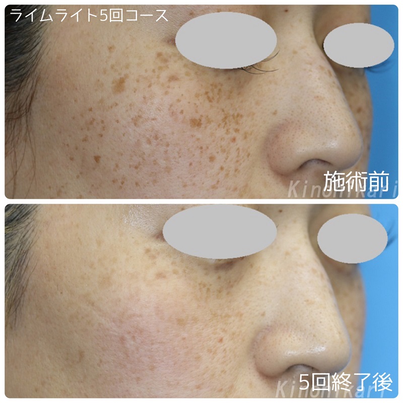 レーザー 光治療器での美白治療 奈良 樹のひかり形成外科 皮ふ科