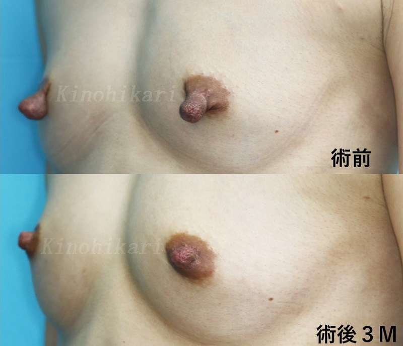 【乳頭縮小】授乳後の乳頭の改善　30代女性【症例No.29Y032511】