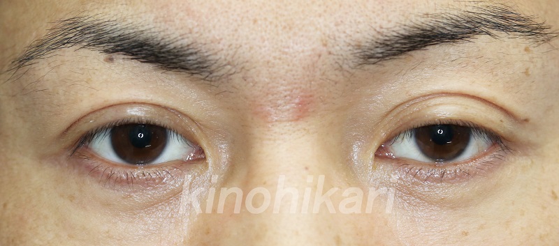 【眼瞼下垂】中等度の眼瞼下垂を自費診療で　40代男性【症例No.29Y060156】