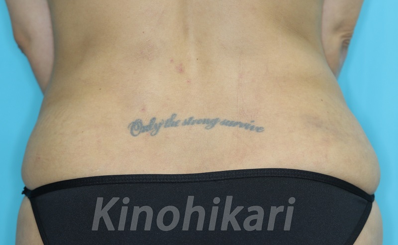 【刺青除去】文字のタトゥーを単純切除で　40代女性【症例No.29Y111327】