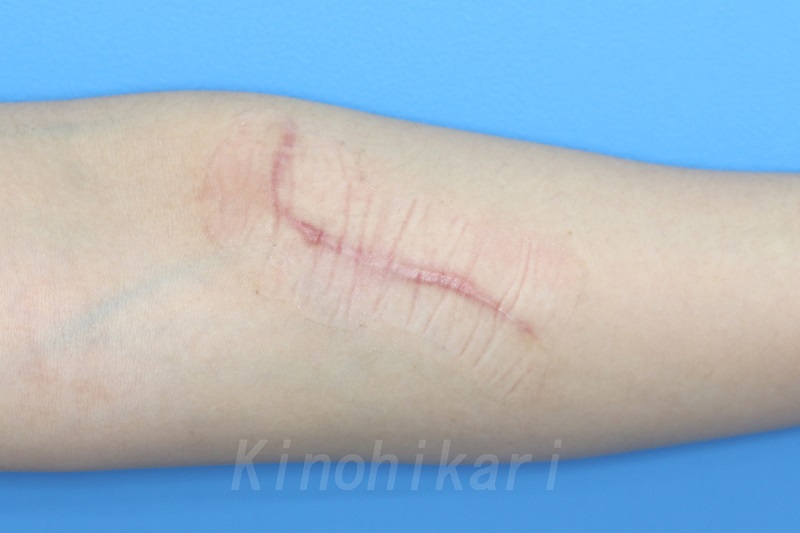 【傷跡修正】左前腕の傷跡　20代女性【症例NO29Y000114】