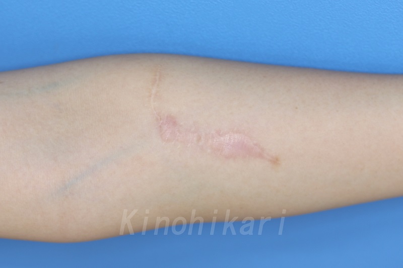 【傷跡修正】左前腕の傷跡　20代女性【症例NO29Y000114】