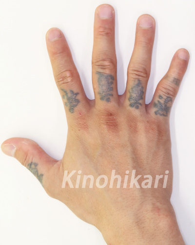 【タトゥー除去】Qスイッチルビーで指のタトゥーを除去　20代男性【症例No.29Y021609】