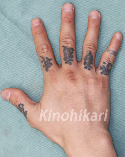 【タトゥー除去】Qスイッチルビーで指のタトゥーを除去　20代男性【症例No.29Y021609】