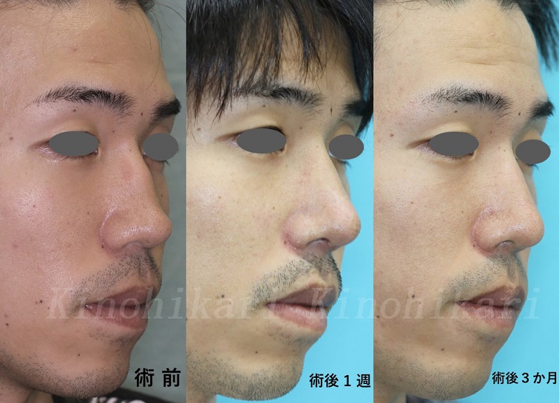 【外傷性斜鼻】他院術後の段鼻・低鼻の修正　20代男性【症例No.29Y071941】