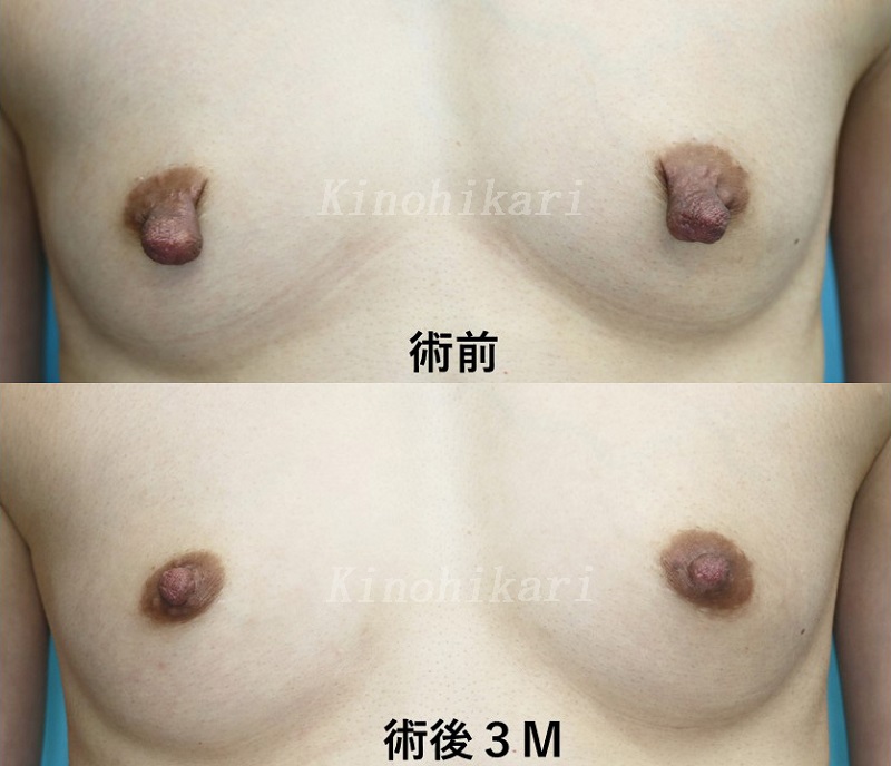 【乳頭縮小】授乳後の乳頭の改善　30代女性【症例No.29Y032511】