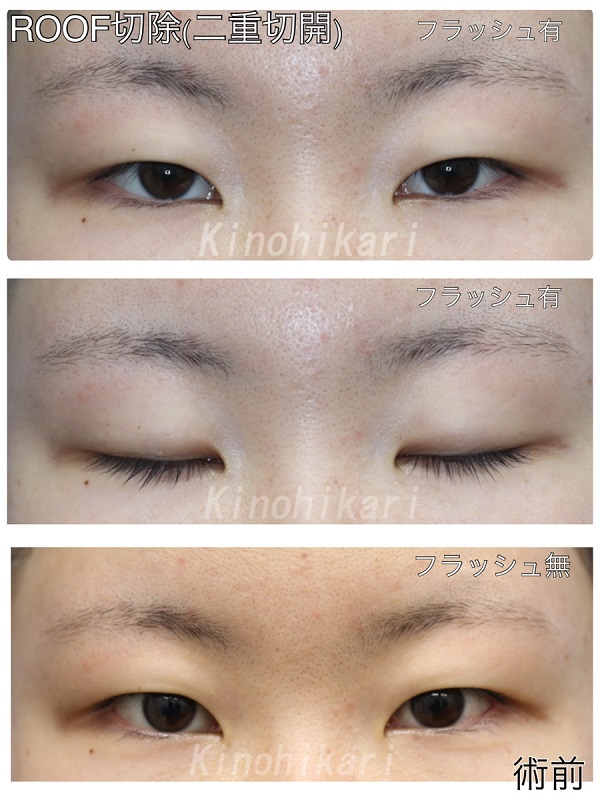 【ROOF切除】目尻側（外側）の厚みを改善させ二重に　10代女性【症例No.29Y0000284】