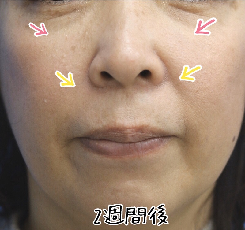 【ヒアルロン酸注入】中顔面・鼻唇溝への注入　50代女性【症例No.29Y020369】