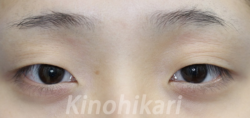 【二重埋没法】眉と瞳の距離の短い平行二重に　10代女性【症例No.29Y041947】