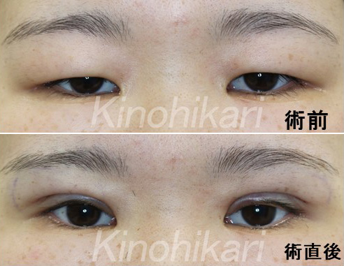 【眼瞼下垂+ROOF切除】厚ぼったい瞼の改善　20代女性【症例No.29Y080263】