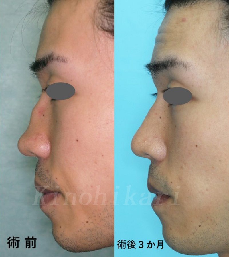 【外傷性斜鼻】他院術後の段鼻・低鼻の修正　20代男性【症例No.29Y071941】