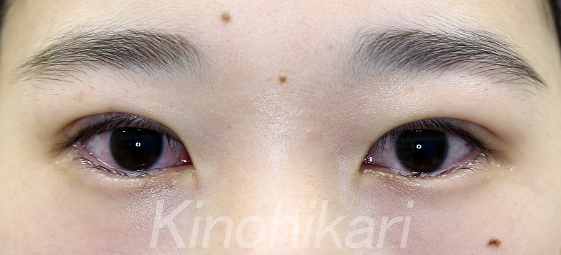 【二重埋没法】厚ぼったい瞼を二重に　10代女性【症例No.29Y0000174】