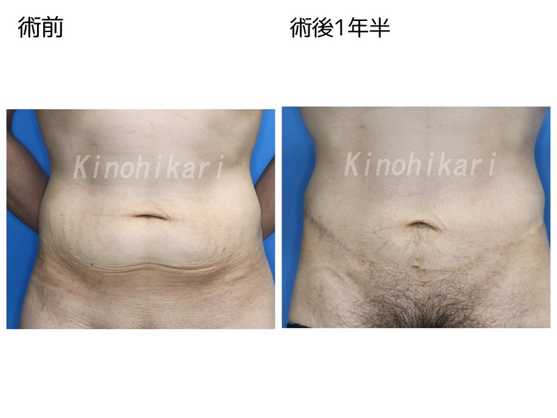 【皮膚切除】ダイエット後の腹部のたるみを切除　30代男性【症例No.29Y0000195】