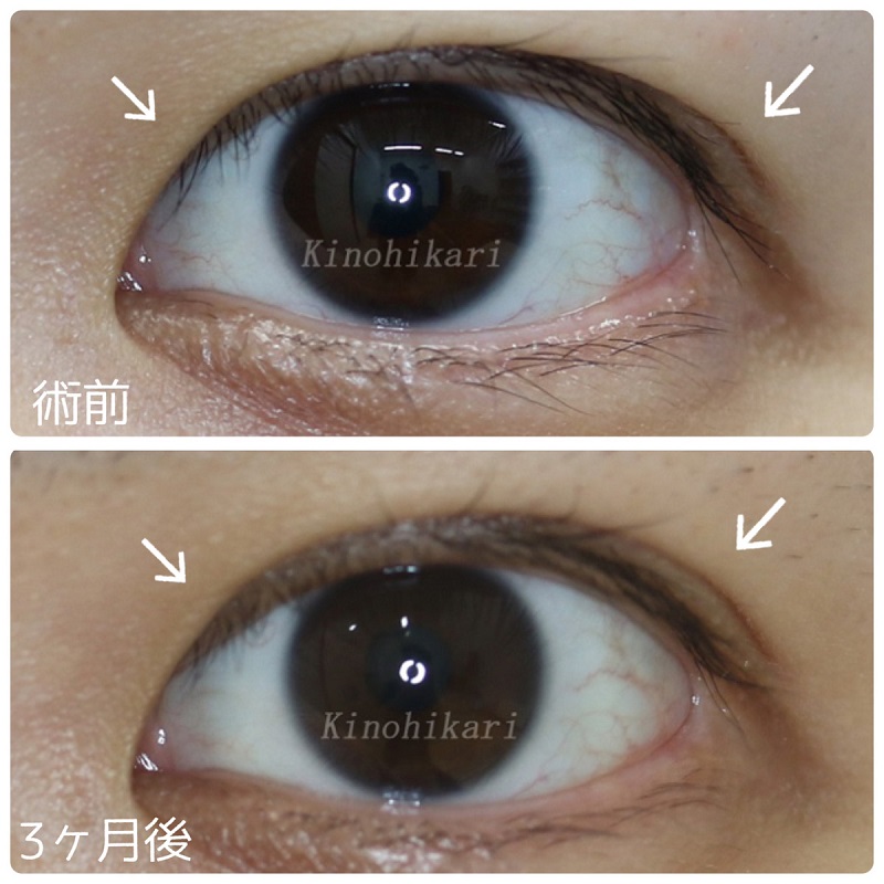 【他院修正】眼瞼下垂手術後の目の開き具合を和らげたい　20代女性【症例No.29Y0000202】