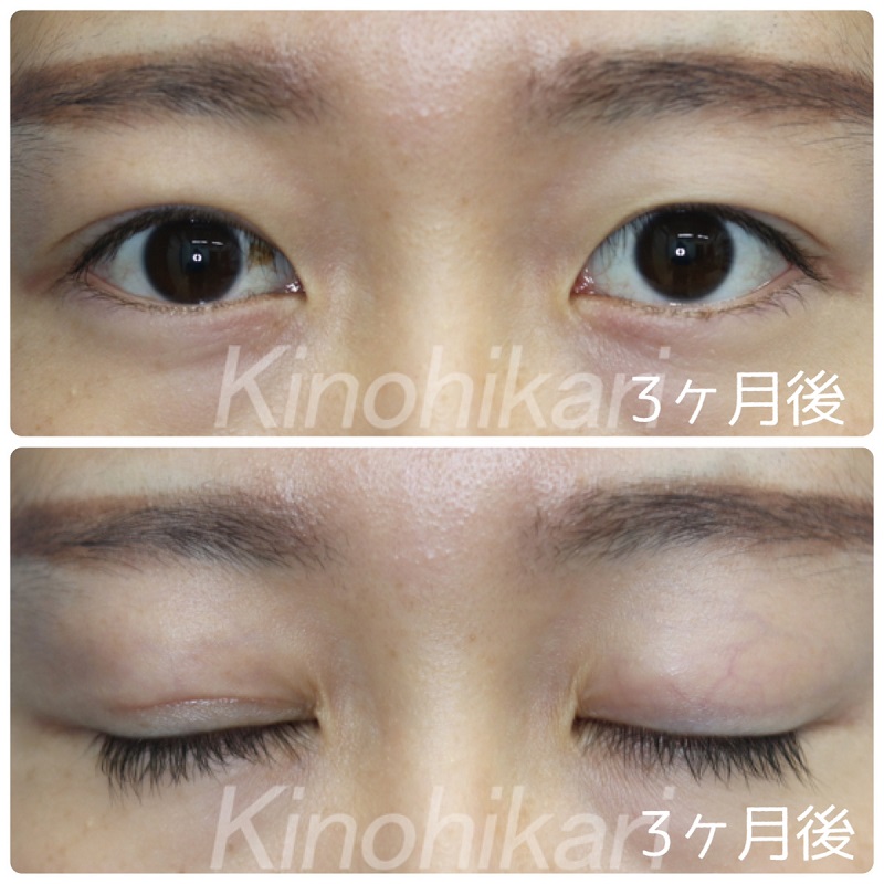 【眼瞼下垂】右眼の先天性眼瞼下垂　20代女性【症例No.29Y0000237】
