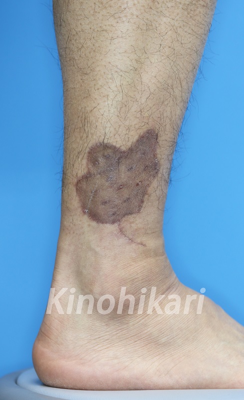 【刺青除去】足首のタトゥーを切除、植皮術　30代男性【症例No.29Y0000194】