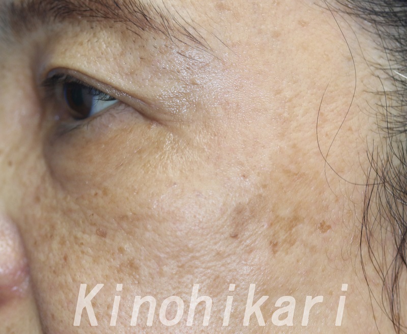 【シミ取りレーザー】左頬の大きなシミに　60代女性【症例No.29Y0000169】