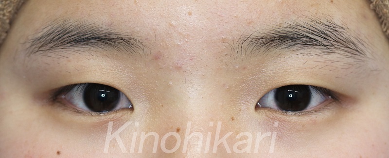 【二重埋没法】厚ぼったい瞼をスッキリ　10代女性【症例No.29H0000275】