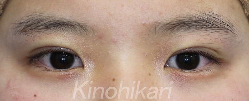 【二重埋没法】厚ぼったい瞼をスッキリ　10代女性【症例No.29H0000275】