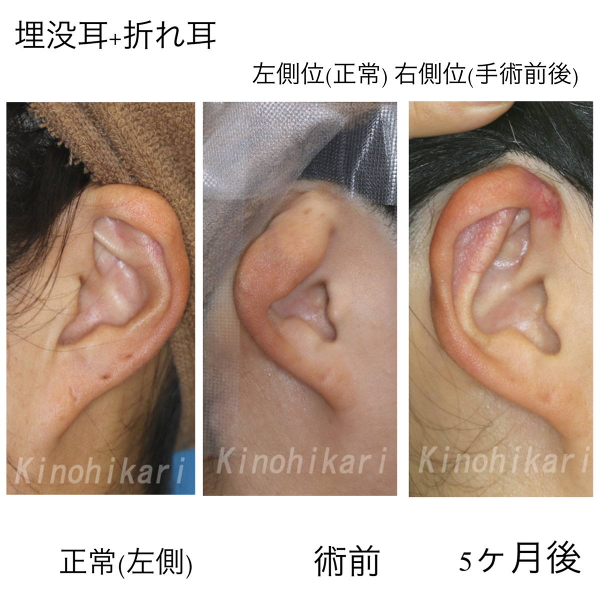 【耳介形成術】埋没耳・折れ耳の改善　30代女性【症例No.29Y0000302】