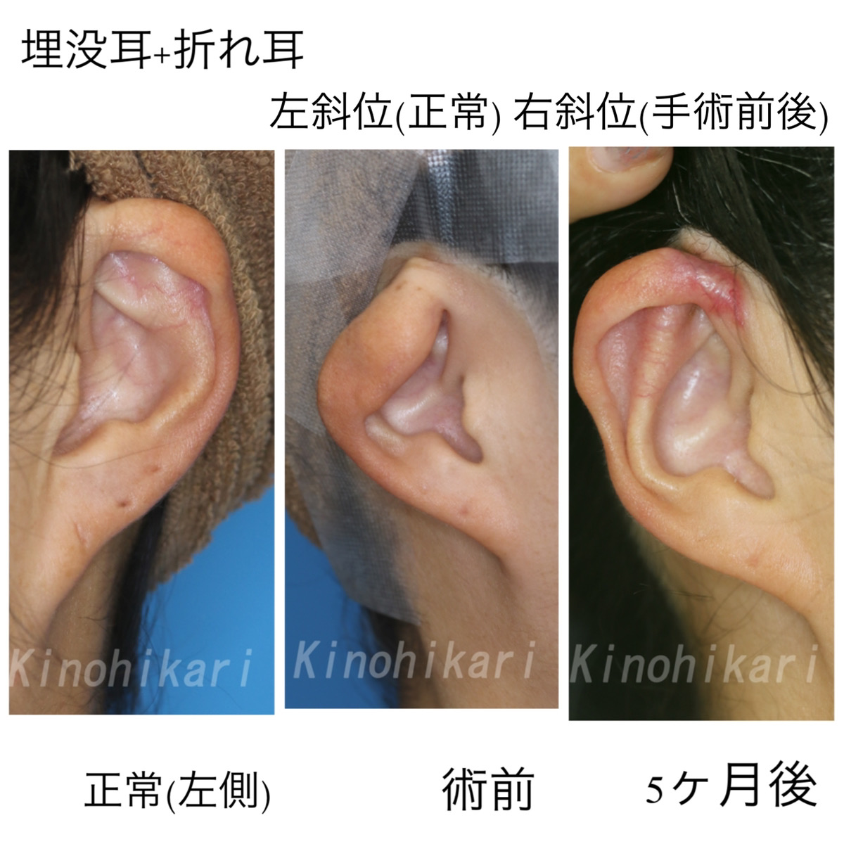 【耳介形成術】埋没耳・折れ耳の改善　30代女性【症例No.29Y0000302】