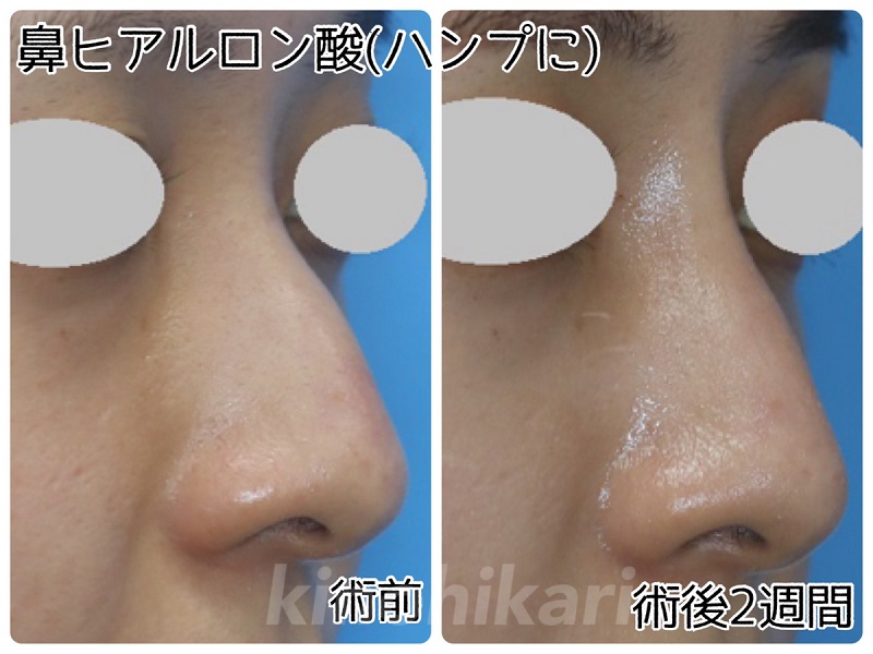 【わし鼻修正】ヒアルロン酸で鼻をまっすぐに　20代女性【症例No.29Y0000328】