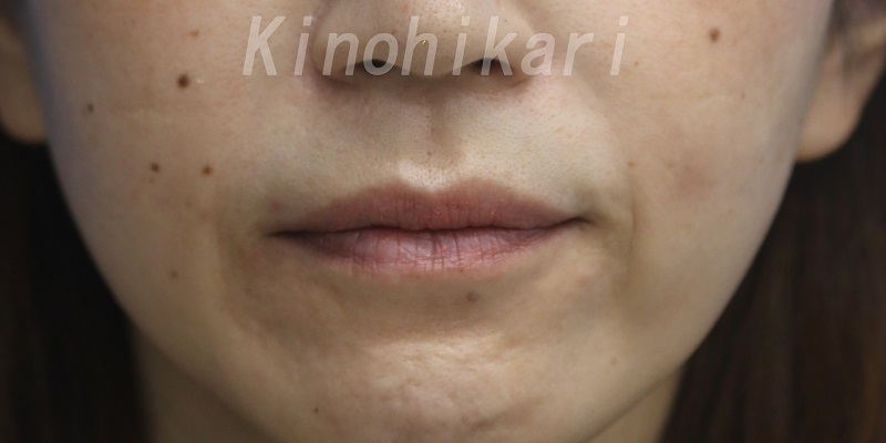 【ヒアルロン酸口角外側】口角外側の浅いしわを改善　40代女性【症例No.29H0000381】