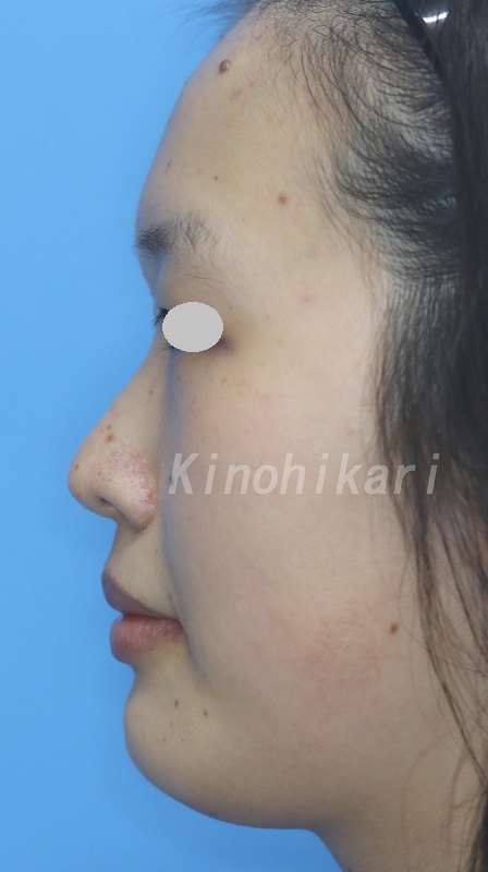 【隆鼻術】鼻プロテーゼ挿入で鼻を高く　20代女性【症例No.29H0000383】