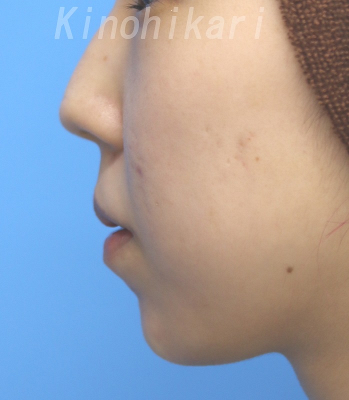 【顎のヒアルロン酸】小さい顎を出して大人っぽく　20代女性【症例No.29H0000399】