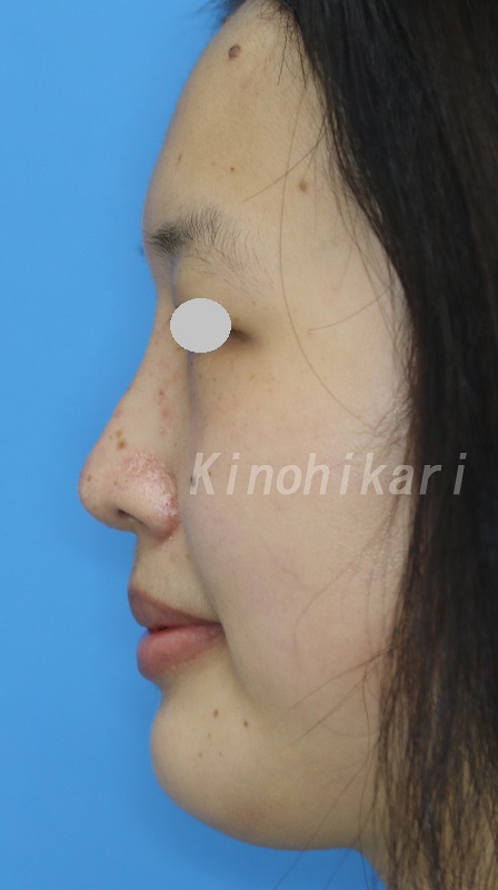 【隆鼻術】鼻プロテーゼ挿入で鼻を高く　20代女性【症例No.29H0000383】