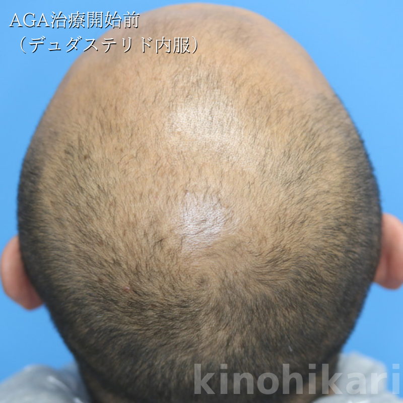 【AGA治療】年々頭皮が薄くなってきた　40代男性【症例No.29Y0000438】