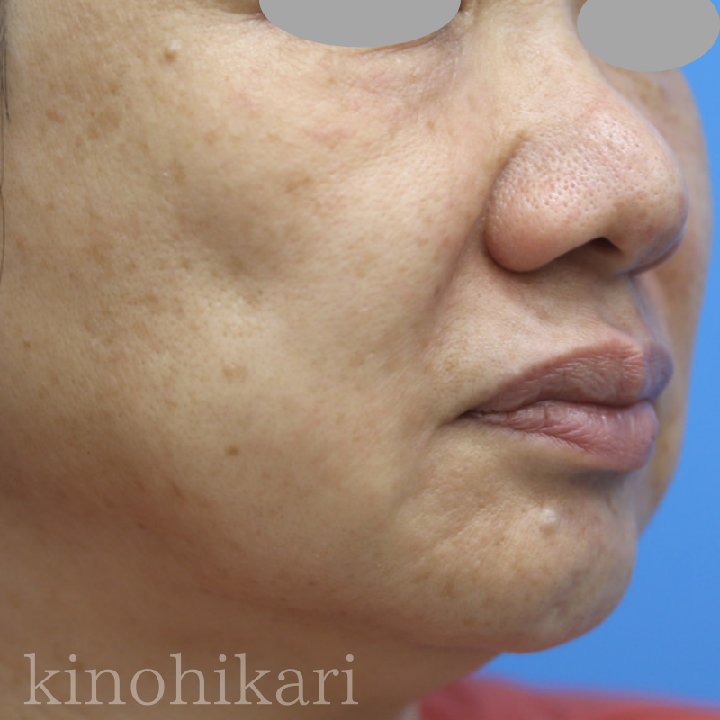 【頬のヒアルロン酸】右頬の凹みが気になる　50代女性【症例No.29Y0000446】
