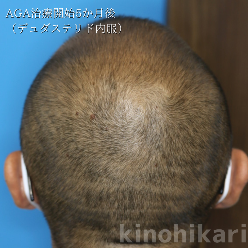 【AGA治療】年々頭皮が薄くなってきた　40代男性【症例No.29Y0000438】