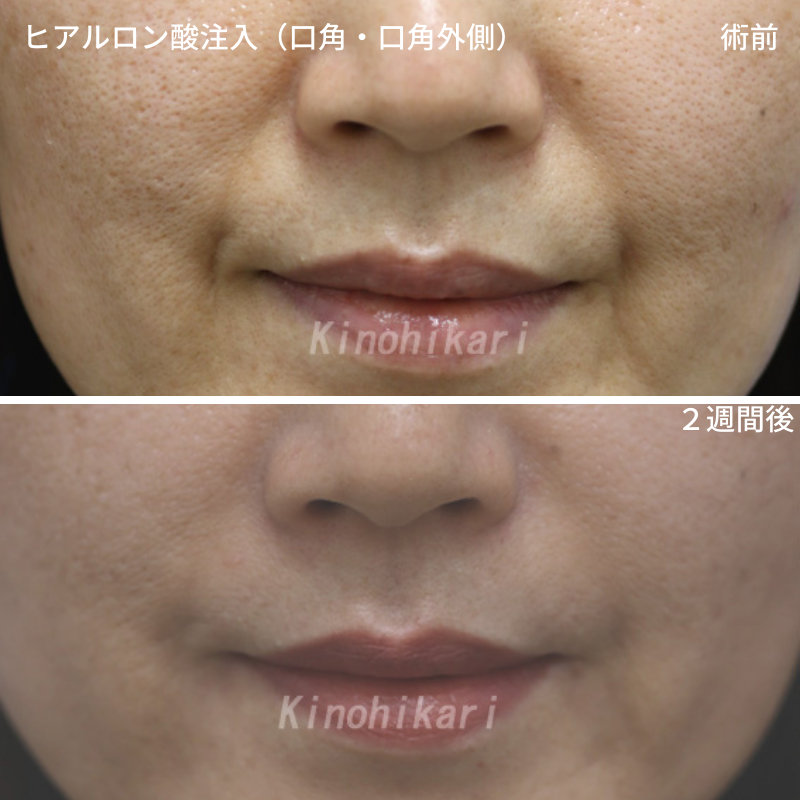 【ヒアルロン酸注入】ほうれい線から口角にかけてのシワ改善　40代女性【症例No.29Y0000475】