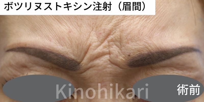 【眉間のしわ】眉間のシワの改善　40代女性【症例No.29Y0000523】
