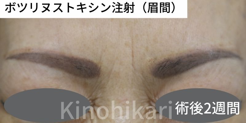 【眉間のしわ】眉間のシワの改善　40代女性【症例No.29Y0000523】