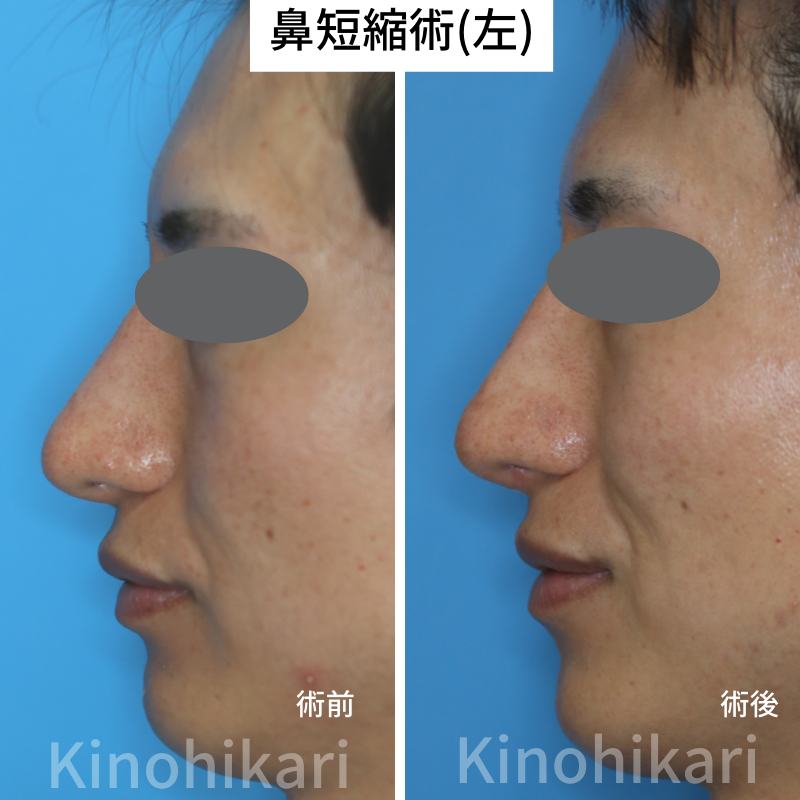 【鼻短縮術】垂れ下がった鼻先を改善させたい30代男性(他院修正)【症例No.29Y00000535】