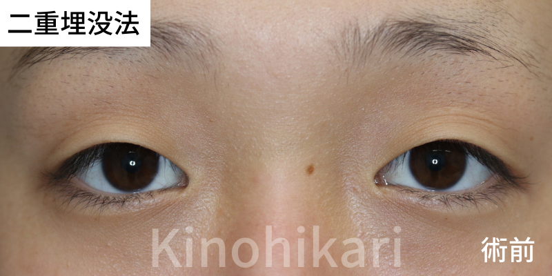 【二重埋没法】重い瞼を持ち上げるために眉を挙上していた方　10代女性【症例No.29Y00000588】