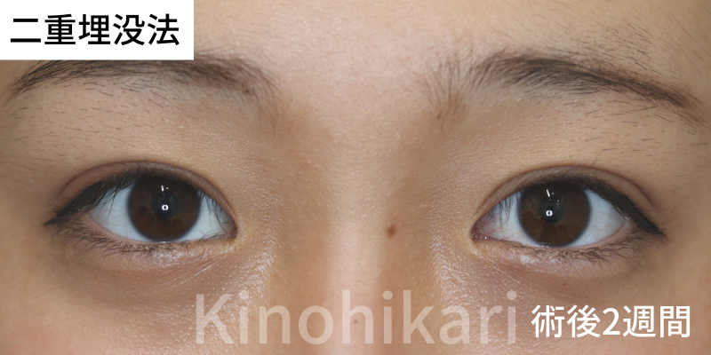 【二重埋没法】重い瞼を持ち上げるために眉を挙上していた方　10代女性【症例No.29Y00000588】
