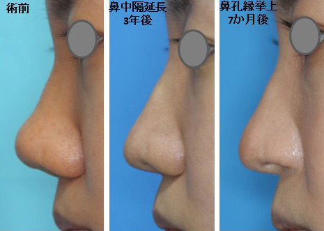 【鼻中隔延長・鼻孔縁挙上術（T型）】鼻柱が極端に短い団子鼻の鼻下1/3を整えたい　20代女性【症例No.29Y0000597】