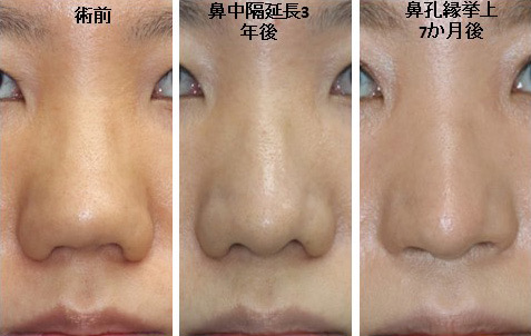【鼻中隔延長・鼻孔縁挙上術（T型）】鼻柱が極端に短い団子鼻の鼻下1/3を整えたい　20代女性【症例No.29Y0000597】
