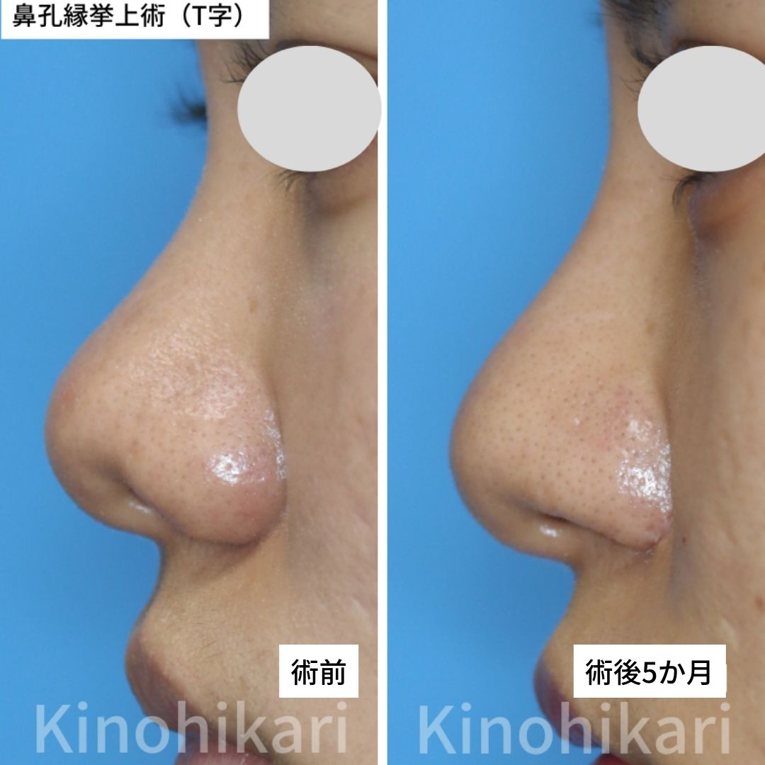 【鼻孔縁挙上術T字】鼻下1/3の重々しさを改善したい　20代女性【症例No.29Y0000633】