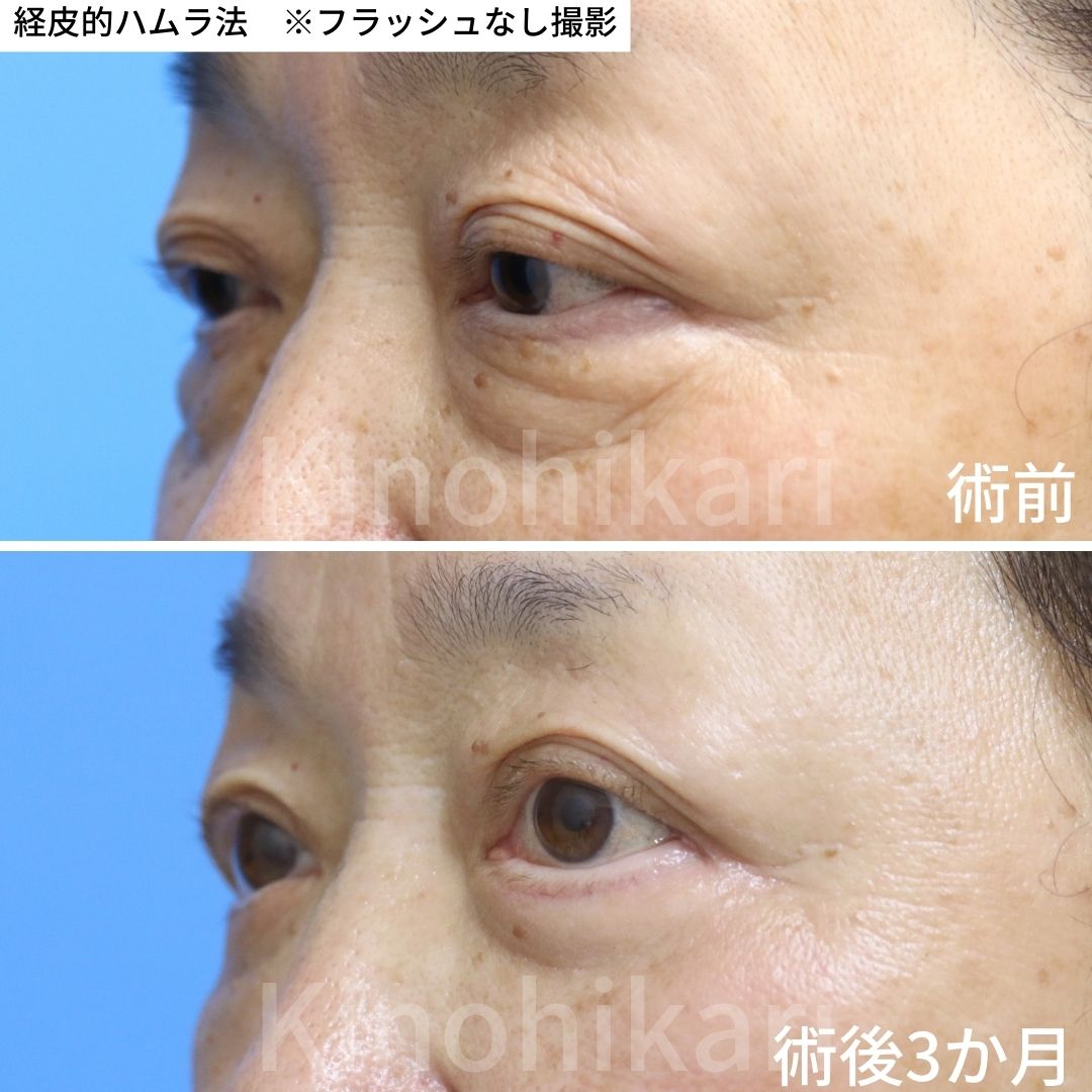 【経皮的ハムラ】目の下の膨らみ・凹み・皮膚のたるみ等、多くの問題点を抱える　60代女性【症例No.29Y0000651】