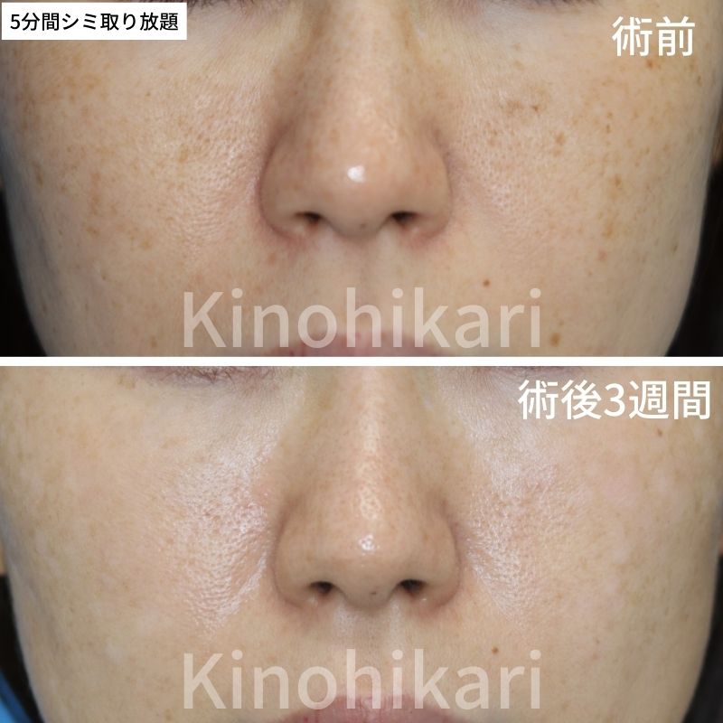 【5分間シミ取り放題】頬のシミの改善　30代女性【症例No.29H0000692】