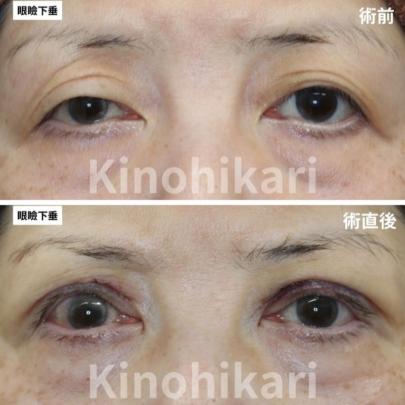 【眼瞼下垂修正】以前手術した眼瞼下垂の左右差が気になる　60代女性【症例No.29Y0000718】