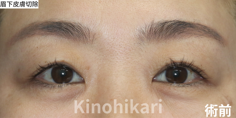 【眉下皮膚切除】厚ぼったい瞼を改善　40代女性【症例No.29Y0000747】